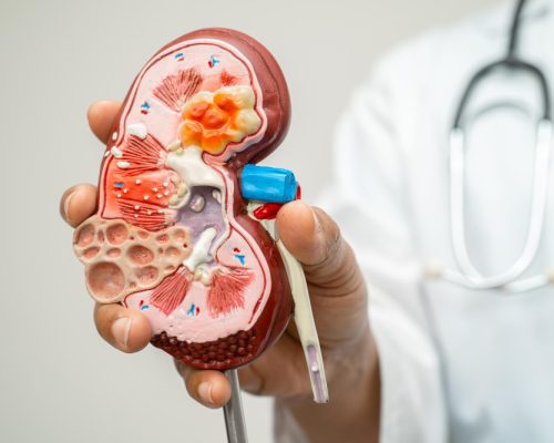 Kidney Stones
